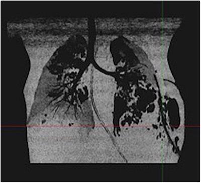 Severe Staphylococcus aureus infections in children: Case reports and management of positive Panton-Valentine <mark class="highlighted">leucocidin</mark> cases
